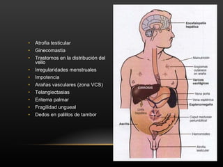 Atrofia testicular Ginecomastia Trastornos en la distribución del vello Irregularidades menstruales Impotencia Arañas vasculares (zona VCS) Telangiectasias Eritema palmar  Fragilidad ungueal Dedos en palillos de tambor 