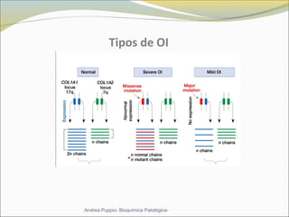 Tipos de OI
Andrea Puppio- Bioquímica Patológica-
 