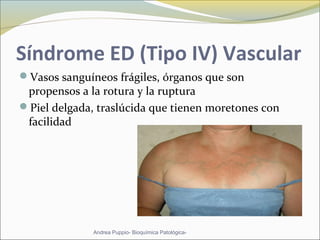 Síndrome ED (Tipo IV) Vascular
Vasos sanguíneos frágiles, órganos que son
propensos a la rotura y la ruptura
Piel delgada, traslúcida que tienen moretones con
facilidad
Andrea Puppio- Bioquímica Patológica-
 