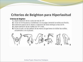 Criterios de Beighton para Hiperlaxitud
Andrea Puppio- Bioquímica Patológica-
 