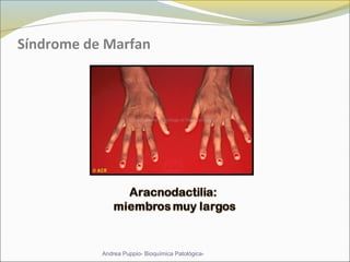 Síndrome de Marfan
Andrea Puppio- Bioquímica Patológica-
 