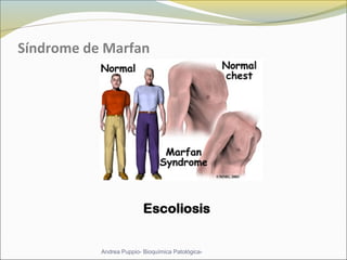 Síndrome de Marfan
Andrea Puppio- Bioquímica Patológica-
 