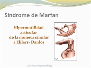 Síndrome de Marfan
Andrea Puppio- Bioquímica Patológica-
 
