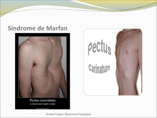 Síndrome de Marfan
Andrea Puppio- Bioquímica Patológica-
 