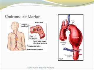Síndrome de Marfan
Andrea Puppio- Bioquímica Patológica-
 