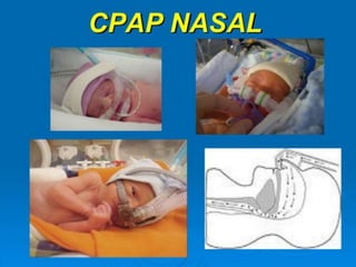 CPAP Nasal 0 - UcinMedica - Evolucionamos juntos por la salud