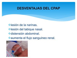 CPAP Nasal 0 - UcinMedica - Evolucionamos juntos por la salud