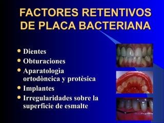 FACTORES RETENTIVOS
DE PLACA BACTERIANA

 Dientes
 Obturaciones
 Aparatologìa
  ortodòncica y protèsica
 Implantes
 Irregularidades sobre la
  superficie de esmalte
 
