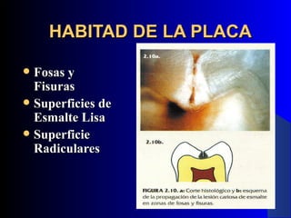 HABITAD DE LA PLACA

 Fosas y
  Fisuras
 Superficies de
  Esmalte Lisa
 Superficie
  Radiculares
 