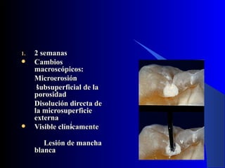 1.   2 semanas
    Cambios
     macroscópicos:
     Microerosión
      subsuperficial de la
     porosidad
     Disolución directa de
     la microsuperficie
     externa
    Visible clínicamente

        Lesión de mancha
     blanca
 