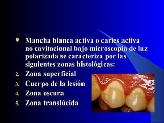     Mancha blanca activa o caries activa
     no cavitacional bajo microscopía de luz
     polarizada se caracteriza por las
     siguientes zonas histológicas:
2.   Zona superficial
3.   Cuerpo de la lesión
4.   Zona oscura
5.   Zona translúcida
 