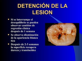 DETENCIÓN DE LA
             LESION
   Si se interrumpe el
    desequilibrio se pueden
    observar cambios de
    regresión clínica
    después de 1 semana
   Se observa disminución
    de la apariencia blanca
    tiza
   Después de 2-3 semanas
    la superficie recupera
    dureza y translucidez
 