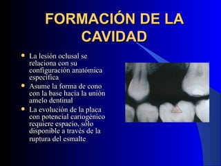 FORMACIÓN DE LA
            CAVIDAD
   La lesión oclusal se
    relaciona con su
    configuración anatómica
    específica
   Asume la forma de cono
    con la base hacia la unión
    amelo dentinal
   La evolución de la placa
    con potencial cariogénico
    requiere espacio, sólo
    disponible a través de la
    ruptura del esmalte
 