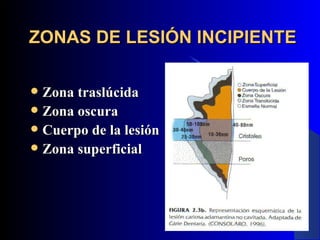 ZONAS DE LESIÓN INCIPIENTE

 Zona traslúcida
 Zona oscura
 Cuerpo de la lesión
 Zona superficial
 