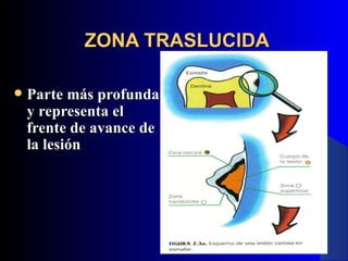ZONA TRASLUCIDA

   Parte más profunda
    y representa el
    frente de avance de
    la lesión
 