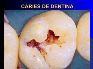 CARIES DE DENTINA
 