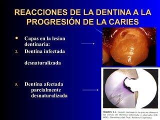 REACCIONES DE LA DENTINA A LA
  PROGRESIÓN DE LA CARIES
    Capas en la lesion
     dentinaria:
2.   Dentina infectada

     desnaturalizada


5.   Dentina afectada
       parcialmente
       desnaturalizada
 
