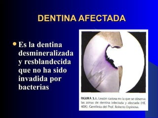 DENTINA AFECTADA

 Es la dentina
 desmineralizada
 y resblandecida
 que no ha sido
 invadida por
 bacterias
 