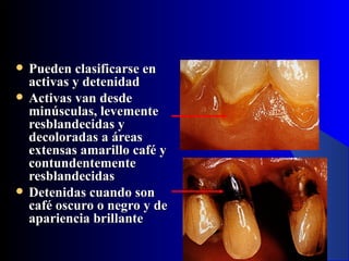    Pueden clasificarse en
    activas y detenidad
   Activas van desde
    minúsculas, levemente
    resblandecidas y
    decoloradas a áreas
    extensas amarillo café y
    contundentemente
    resblandecidas
   Detenidas cuando son
    café oscuro o negro y de
    apariencia brillante
 
