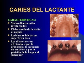CARIES DEL LACTANTE
CARACTERISTICAS:
 Varios dientes están
  involucrados
 El desarrollo de la lesión
  es rápido
 Lesiones se inician en
  superficies lisas
 Los dientes se van
  afectando según la
  cronología, la secuencia
  de erupción y por la
  posición de la lengua al
  succionar
 