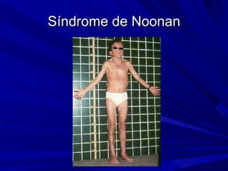 Síndrome de Noonan 