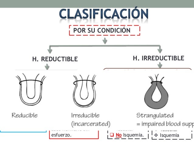Clase de Hernia inguinal