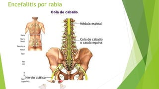 Encefalitis por rabia
 