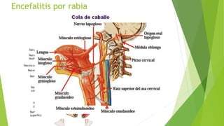 Encefalitis por rabia
 