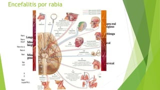 Encefalitis por rabia
 