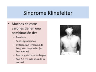Síndrome Klinefelter
• Muchos de estos
varones tienen una
combinación de:
– Escoliosis
– Senos agrandados
– Distribución femenina de
las grasas corporales ( en
las caderas)
– Brazos y piernas más largos
– Son 2-5 cm más altos de lo
normal
 