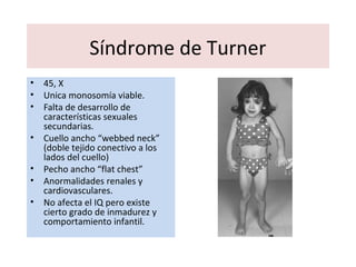 Síndrome de Turner
• 45, X
• Unica monosomía viable.
• Falta de desarrollo de
características sexuales
secundarias.
• Cuello ancho “webbed neck”
(doble tejido conectivo a los
lados del cuello)
• Pecho ancho “flat chest”
• Anormalidades renales y
cardiovasculares.
• No afecta el IQ pero existe
cierto grado de inmadurez y
comportamiento infantil.
 