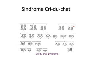 Síndrome Cri-du-chat
 