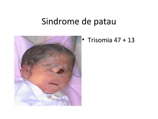 Sindrome de patau
• Trisomia 47 + 13
 