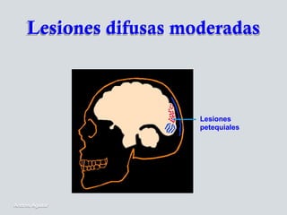 Lesiones
petequiales
Lesiones difusas moderadas
Andres Aguilar
 