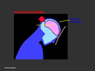 Encefalo
Boveda
Craneana
CONTUSION CEREBRAL
Andres Aguilar
 