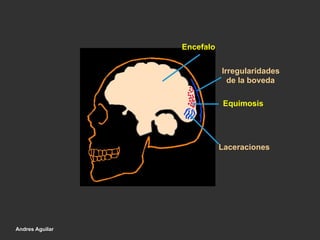 Encefalo
Irregularidades
de la boveda
Equimosis
Laceraciones
Andres Aguilar
 