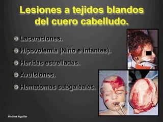 Lesiones a tejidos blandos
del cuero cabelludo.
!   Laceraciones.
!   Hipovolemia (Niño e infantes).
!   Heridas estrelladas.
!   Avulsiones.
!   Hematomas subgaleales.
Andres Aguilar
 
