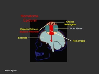 Hemorragia
Hematoma
Epidural
Espacio Epidural
Espacio Potencial
Encefalo
Arterias
Meningeas
Dura Madre
Andres Aguilar
 