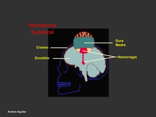 Dura
Madre
Hematoma
Subdural
HemorragiaEncefalo
Craneo
Andres Aguilar
 