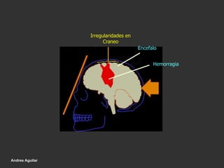 Irregularidades en
Craneo
Encefalo
Hemorragia
Andres Aguilar
 