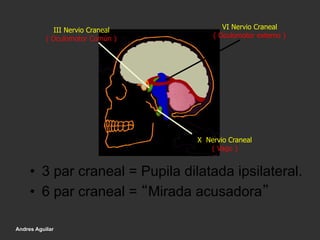 III Nervio Craneal
( Oculomotor Común )
X Nervio Craneal
( Vago )
VI Nervio Craneal
( Oculomotor externo )
•  3 par craneal = Pupila dilatada ipsilateral.
•  6 par craneal = “Mirada acusadora”
Andres Aguilar
 
