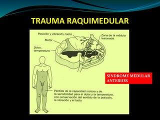 TRAUMA RAQUIMEDULAR 
SINDROME MEDULAR 
ANTERIOR 
 