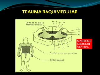 TRAUMA RAQUIMEDULAR 
SINDROME 
MEDULAR 
CENTRAL 
 