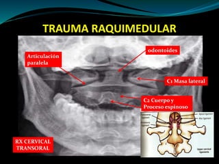 TRAUMA RAQUIMEDULAR 
RX CERVICAL 
TRANSORAL 
odontoides 
C1 Masa lateral 
C2 Cuerpo y 
Proceso espinoso 
Articulación 
paralela 
 