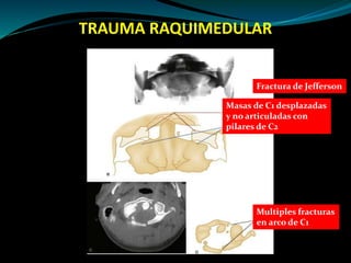 TRAUMA RAQUIMEDULAR 
Fractura de Jefferson 
Masas de C1 desplazadas 
y no articuladas con 
pilares de C2 
Multiples fracturas 
en arco de C1 
 