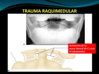 TRAUMA RAQUIMEDULAR 
Asimetria de la 
masa lateral de C1 con 
el odontoides 
 