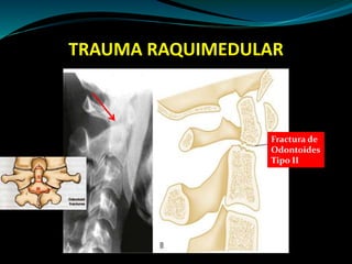 TRAUMA RAQUIMEDULAR 
Fractura de 
Odontoides 
Tipo II 
 