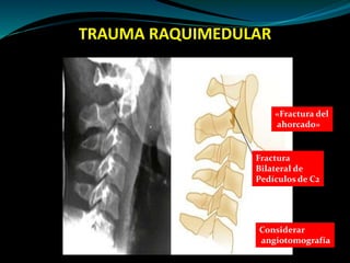 TRAUMA RAQUIMEDULAR 
«Fractura del 
ahorcado» 
Fractura 
Bilateral de 
Pedículos de C2 
Considerar 
angiotomografía 
 