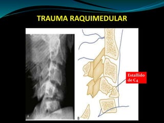 TRAUMA RAQUIMEDULAR 
Estallido 
de C4 
 