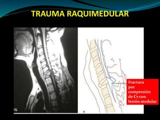 TRAUMA RAQUIMEDULAR 
Fractura 
por 
compresión 
de C7 con 
lesión medular 
 